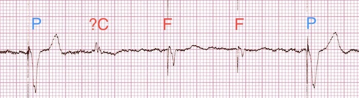 P = paceli vuru, F = füzyon vurusu, C = yakalama vurusu Kaynak : lifeinthefastlane.com - ECG library