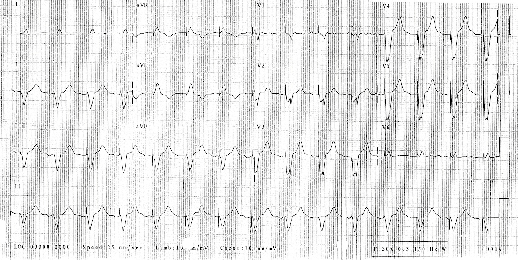 Kaynak : lifeinthefastlane.com - ECG library