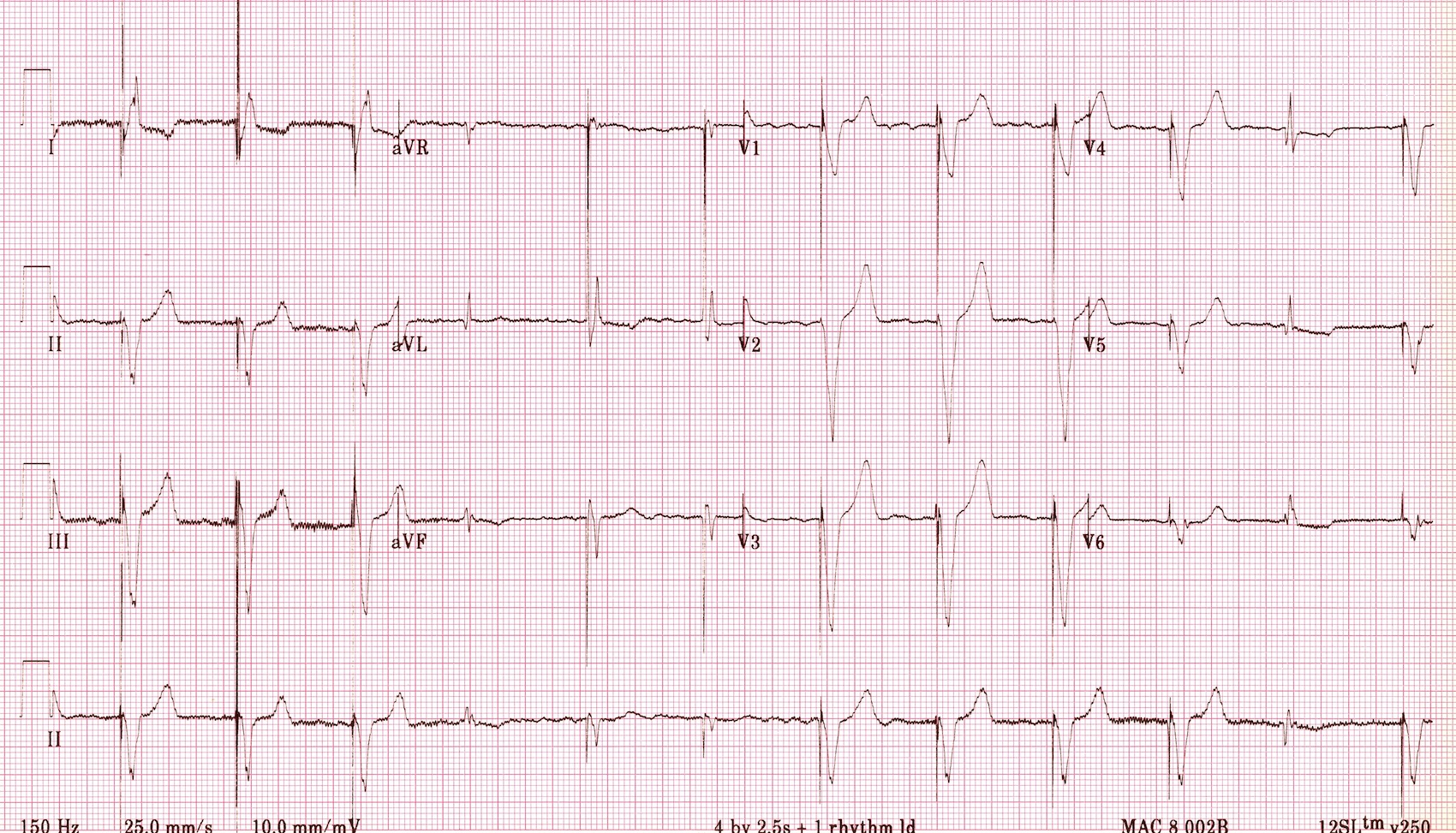 Kaynak : lifeinthefastlane.com - ECG library
