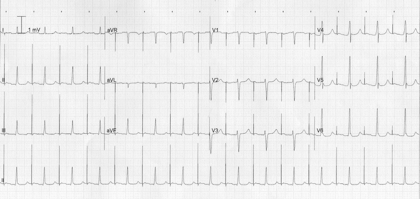 Kaynak : lifeinthefastlane.com - ECG library