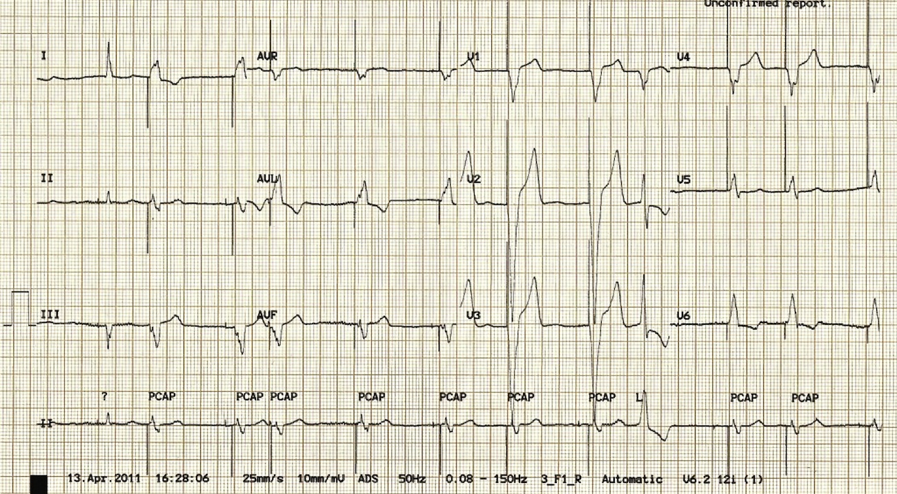 A = atriyal pace spikeı, V = ventriküler pace spikeı, E = ventriküler ektopik vuru Kaynak : lifeinthefastlane.com - ECG library