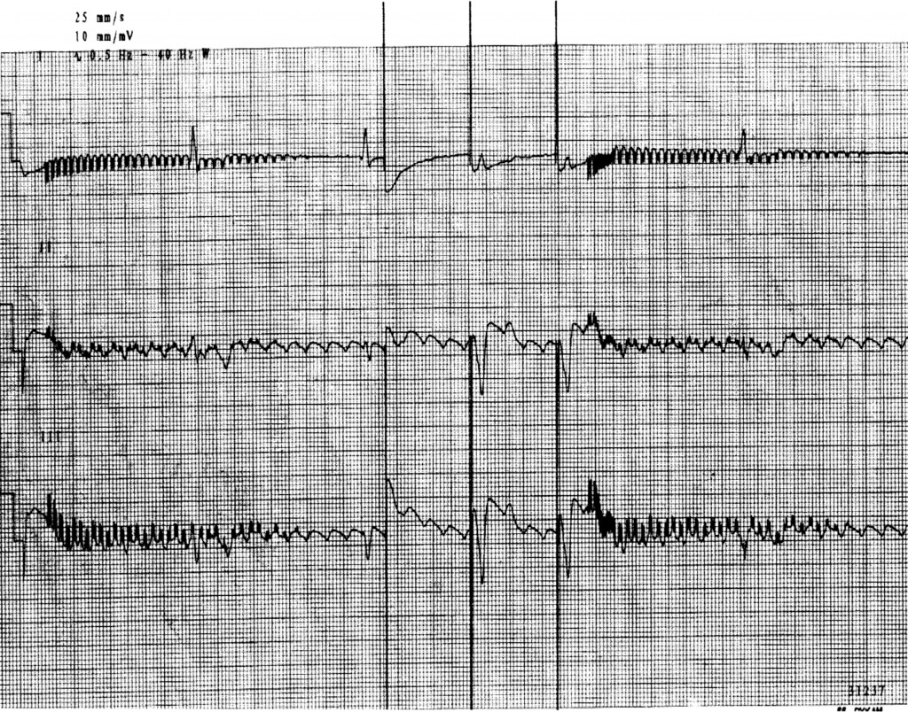 Kaynak : lifeinthefastlane.com - ECG library