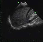 Fig 14: Karacaiğer süperior, anterior ve inferiorunda serbest sıvı