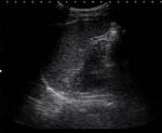 Fig 16: Normal perisplenik pencere