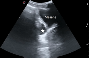 Temel Ultrasonografi - EFAST 15 Mesane posteriorunda serbest sıvı