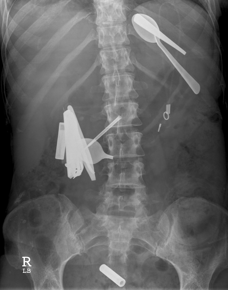 Gastrointestinal yabancı cisim