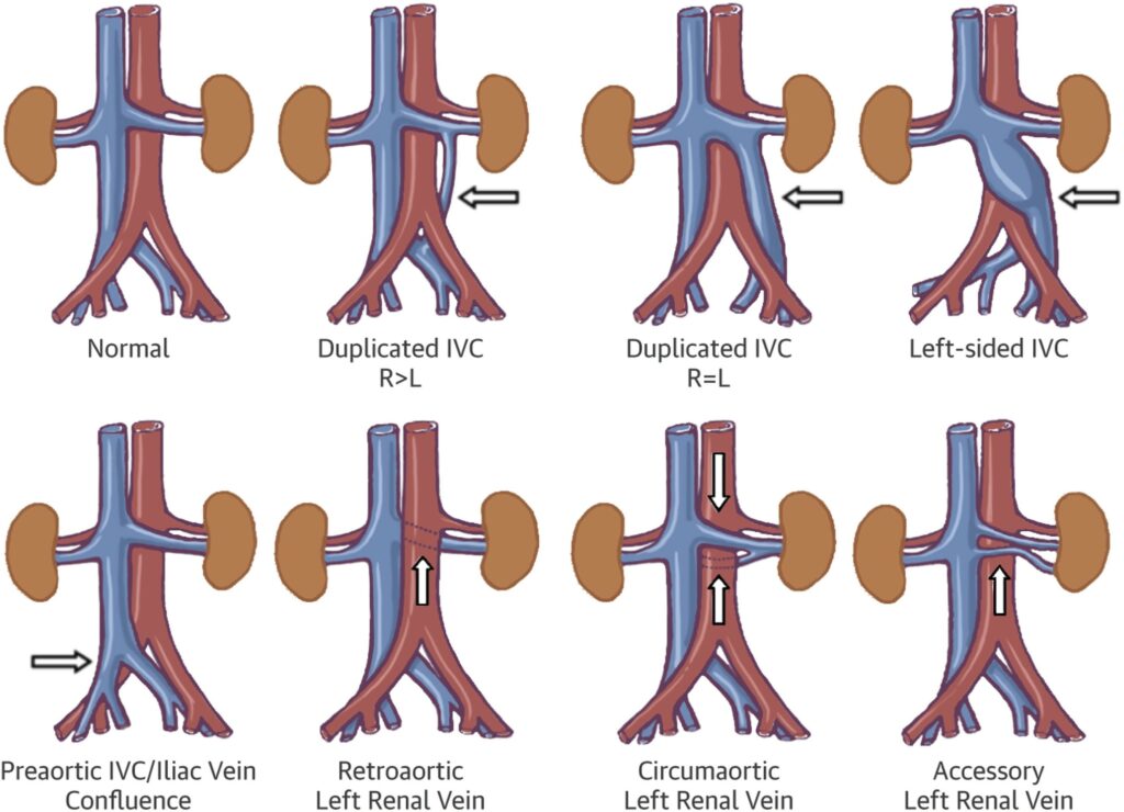 Konjenital vena kava inferior anomalileri