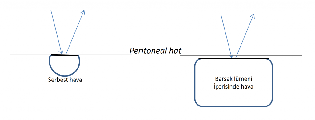 Serbest hava varlığında peritoneal çizgide belirginleşme ve hiperekojen görünüm oluşurken, barsak lümeni içerisindeki hava peritoneal hattın devamı olarak izlenmez.