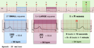 ECG RATE rhythm strip 10 seconds 300 1500 rules ECG 768x399