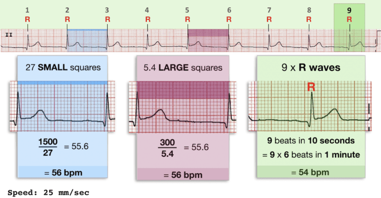 normal kalp atış hızı hesaplayıcısı yüksek tansiyonun neden olduğu kalp hastalığı