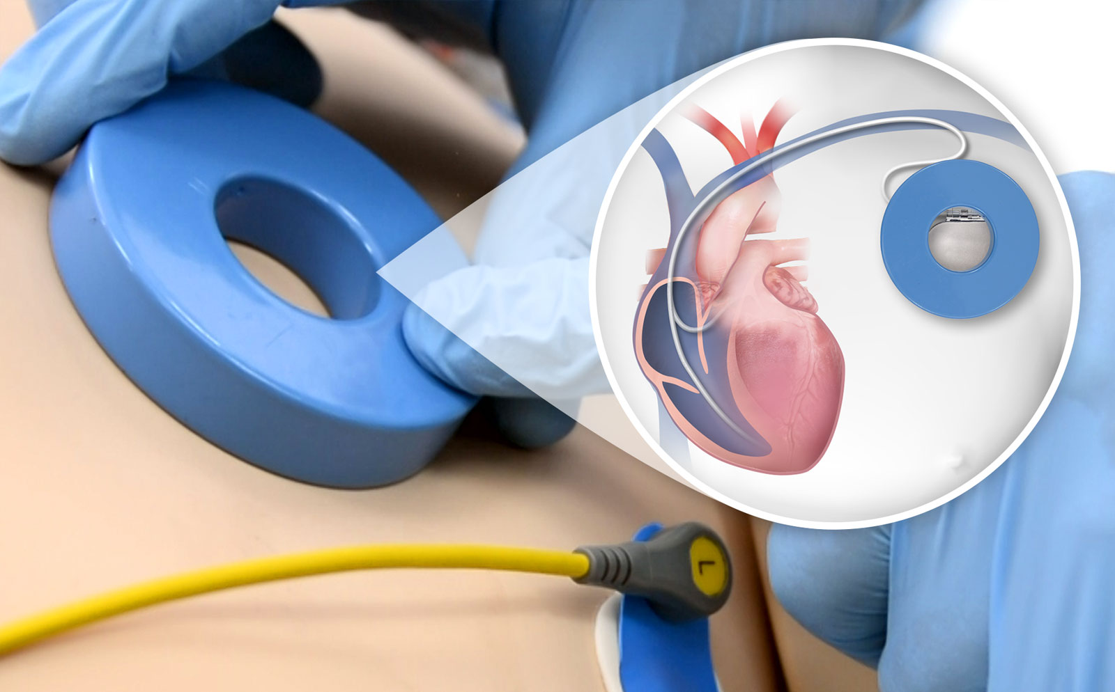 İmplante Edilebilir Kardiyoverter Defibrilatör (ICD) Şoklarının Yönetimi 1