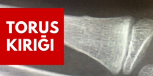 Torus KIRIGI
