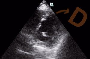 Pulmoner Hipertansiyon Acil Yönetimi - I 4 D görünümü