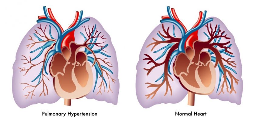 Pulmoner Hipertansiyonda Odaklanmış Ekokardiyografi – II 1