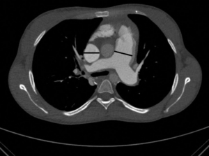 Pulmoner Hipertansiyon Acil Yönetimi - I 5 Pulmoner arter çapı, çıkan aortadan geniş.